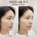 하이코코이비인후과의원 | 하이코 + 매직코 + 코필러 시술, 명동에서 자연스럽게 예뻐진 코라인 내돈내산 후기