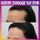 [20대 여성 넓은 이마 M자 머리심기] 비절개 히든컷 2900모 1년 후기 (모엠의원/헤어라인/전지훈원장) 이미지