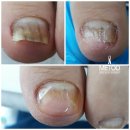 나도손톱 레푸스 개봉점 이미지