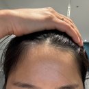 헤어팡팡 & 가발 | [합정 뷰티]헤어라인 컴플렉스 극복기 '유주얼' 헤어팡팡 시술 후기
