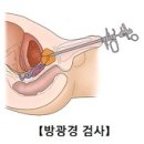 전립선암 (Prostate cancer) 이미지