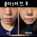 콜라당 | [영등포피부과] 3회차 콜라스터후기 솔직하게남겨볼게요!