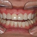 갤러리치과의원 | 여의도 갤러리치과 무삭제 라미네이트 후기, 윗니 8개만 바꿨는데 인상이 정말 달라졌어요