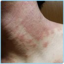 삼생한의원 | 부천아토피치료 만성질환으로 변질되기 전에