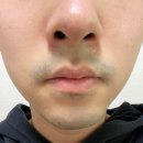 수지침(야간) | 중랑구 인근 피부과 남자 수염 레이저 제모 후기(첫날편)