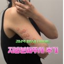 (주)팻라인 | 강남역 피부과 다이어트 | 팻듀스 팔뚝 지방분해주사 24cc 후기