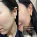 디지털스킨 | 구로디지털단지피부과 스킨부스터 콜라스터 와 토닝 리얼 후기