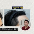 진헤어라인 이미지