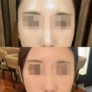 귀일지 | 강남 귀필러 요정귀 후기 가격 비용 내돈내산 (이벤트)