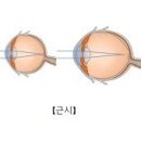 라섹/라섹수술 잘하는곳에서 라섹,라섹수술/라섹수술후기 이미지