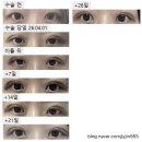 거상스쿨 | 매몰 쌍꺼풀 수술 한 달 기록, 인라인 쌍커풀 붓기 변화 리얼 후기 공개 (내돈내산)