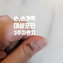 미드림이피부과의원 | 3주걸린 손 손가락 대상포진 헤르페스 완치이야기 (에스로반,아시클로버 사용)