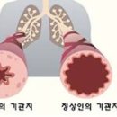 기관지 천식 검사 치료 기관지 천식 기침 원인 증상 기관지 천식 음식 이미지