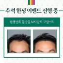 탈모병원비용!! 모발이식 290부터~ 이렇게 저렴해?? 이미지