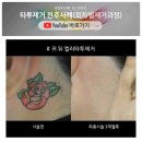 ​타투제거 후기 비용 비교해 보면
