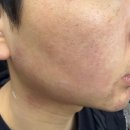 플러스후노원의원 | 내돈내산ㅣ노원 피부과, 노원 남성제모, 노원 스노우의원 찐후기 (화이트닝 젠틀맥스 패키지)