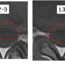 새끈승희 님의 요추디스크 L2-3, L3-4의 MRI 사진 판독입니다. 이미지