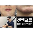 브라질리언제모 후기 젠틀맥스프로플러스를 이용하면 깔끔!