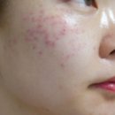 구은희피부 | 정왕동기미 잡티 싹 지운 피부지우개관리 :: 구은희에스테틱 (열흘 뒤 후기)