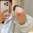 웰던필라테스 | 팔꿈치 색소침착 피코토닝 5회차 | 레이저 후 더 까매졌다? 흑꿈치 다운타임 경과 (+가격)