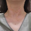 아미한의원 | 내돈내산 병원 두 곳 편평사마귀 co2 레이저 제거 찐후기