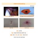 담석증수술후기. 배 중간 부위가 누르면 아프고, 가끔씩 오른쪽 옆구리도 쑥쑥 쑤시고 아파서, 담낭절제수술을 감행하게 되었습니다. 이미지