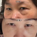 [part.2] 강남 눈밑지방재배치 60대 엄마 병원 눈밑지 수술 당일 후기, 붓기 멍 , 수술 전/후
