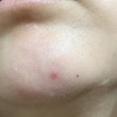 마이크로짐 | 마이크로 니들 패치 추천, 더마클래식 여드름 니들 패치 솔직 후기