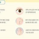 가와사키병 원인 증상 치료 아기 발진 고열 이미지