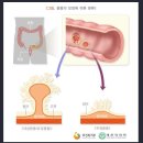 대장용종제거수술비 (급여, 용종 개수당)보장 특별약관[무배당 메리츠 또 걸려도 또 받는 암보험2210(1종)] 이미지