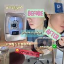 군산솔레에스테틱 군산여드름피부관리추천 이벡시아플라즈마