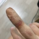 세제한의원 | 한포진 호전 후기 - 재발, 원인, 수포, 증상