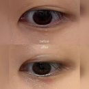 맑은약국 | 신도림역 피부과 비립종 제거 후기 | 더맑은의원 내돈내산