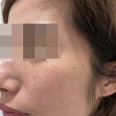 대로약국 | 도미나크림 약국 기미 잡티 약국템 비포애프터 후기