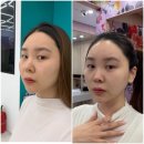 명의원 | 수원 세모아의원 티타늄리프팅 70 kj 솔직후기