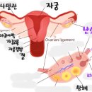 난소암은 왜 3기 이상일까? 이미지