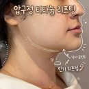 부티나네 | 압구정역피부과 하이퍼 티타늄 리프팅 6만줄 솔직 후기 | 턱선 시술 내돈내산