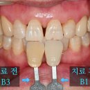 보스톤미소치과의원 | 수원 치아 미백 추천, 원데이 전문가 미백의 모든 것, 치료전후 후기와 주의점