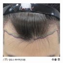 1045 | 인천 비절개모발이식,1045모낭 이식 수술 케이스 후기
