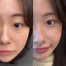 여의도 | 여의도피부과 포텐자후기 모공축소 효과 통증