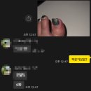 20대 여자 내성발톱으로 레푸스 다녀온 후기..🥹ㅣ광화문종로레푸스 🦶🏻