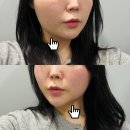 타이트짐 | 광명피부과 올타이트리프팅 400샷 처진 얼굴 해결 후기