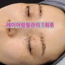 브니엘메디칼 | [구미피부관리] 브니엘뷰티에서 레이어링필관리 1회차 받고 온 후기 ❤️
