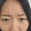 안나의뜰 | 주름 보톡스 이마 미간 콧등 3부위 10일 경과 효과 부작용 리얼 내돈내산 솔직 후기