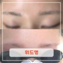 갱고개로 121-8, (연수동) | [인천︱연수구] 인천잔흔제거 연수동 잔흔제거 잘하는 곳 위드영 눈썹 잔흔제거 1회 후기