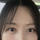 달이뜨는밤 | 원래 쌍꺼풀 있는데도 자연유착 쌍수한 이유｜한 달 후기, 붓기·짝짝이 솔직 기록