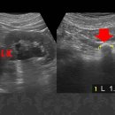 Mild hydronephrosis를 동반한 Lt. ureteral stone 이미지