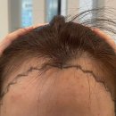 모프로의원 | 서울 강남구 신사동 탈모관리 모프로의원 위치 가격 후기