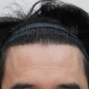 뉴헤어보고서 | 부산 비절개 모발이식으로 고밀도와 높은 생착률 1년 후기