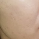 제성 | 천안문제성피부 관리 에버림 여드름관리 후기 두정동 압출잘하는곳